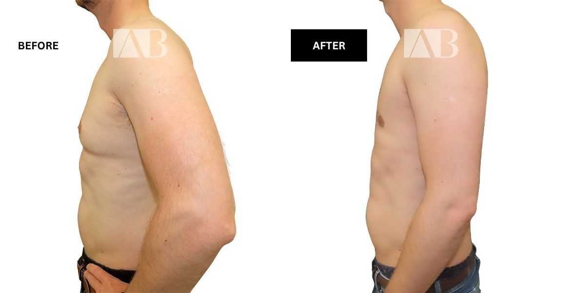 Male Breast Reduction Before and After Photo – Patient 1 Left Side