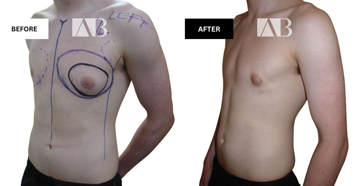 Male Breast Reduction Before and After Photo – Patient 2 – 45 degree