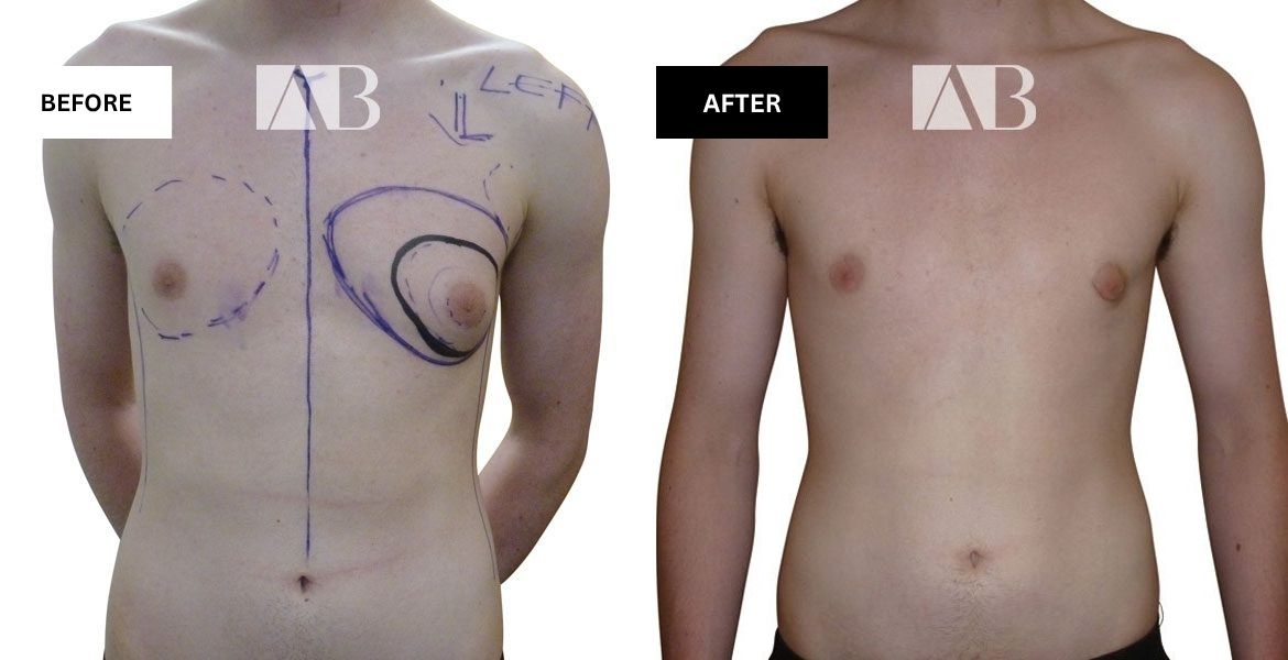 Male Breast Reduction Before and After Photo – Patient 2 Front View