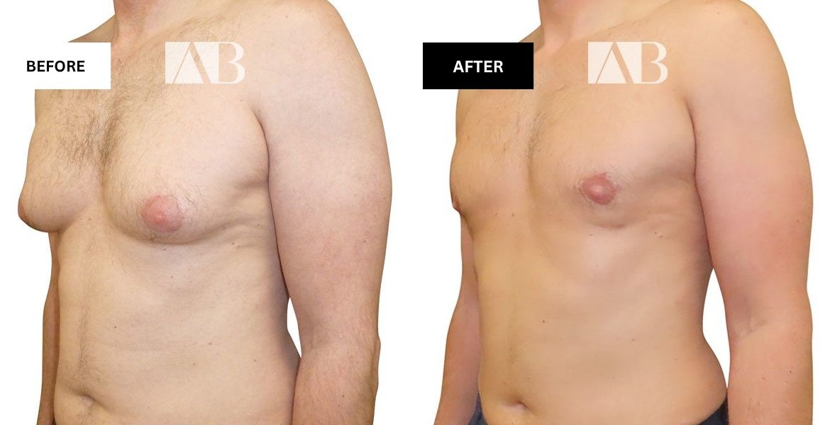 Male Breast Reduction Before and After Photo – Patient 3 – 45 degree