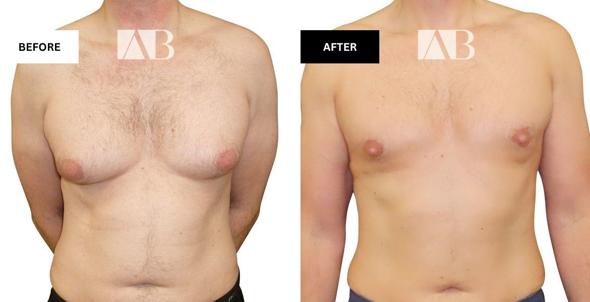 2025 Breast Reduction Gallery Featured Image