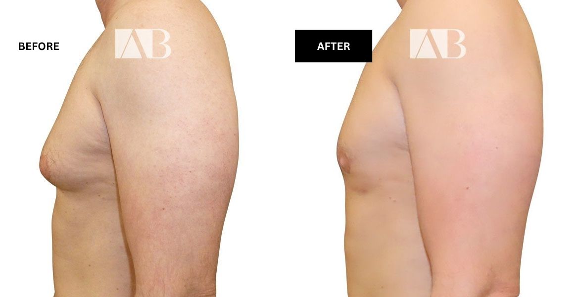 Male Breast Reduction Before and After Photo – Patient 3 Left Side