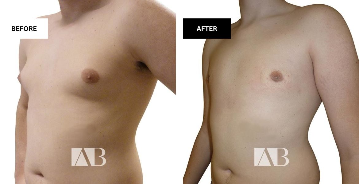 Male Breast Reduction Before and After Photo – Patient 4 – 45 degree