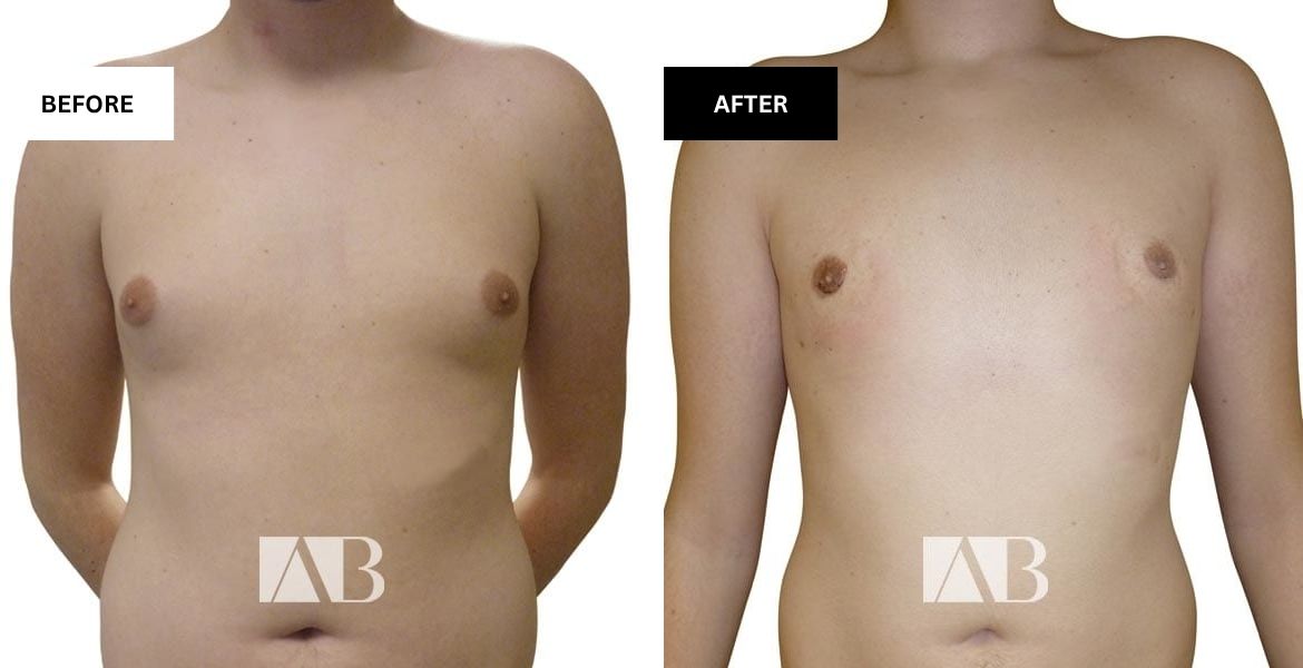 Male Breast Reduction Before and After Photo – Patient 4 Front View