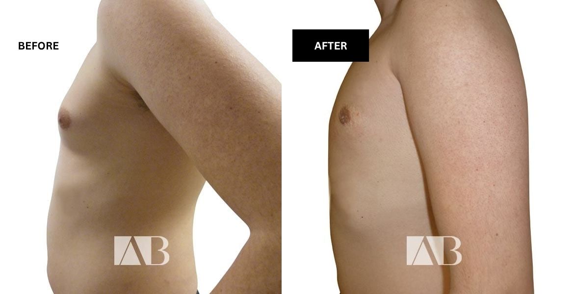 Male Breast Reduction Before and After Photo – Patient 4 Left Side
