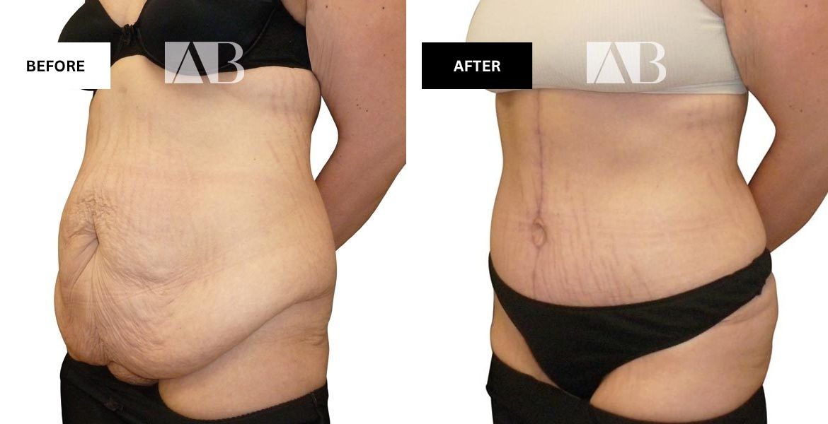 Tummy Tuck Before and After Photo Patient 8 - 45 degree