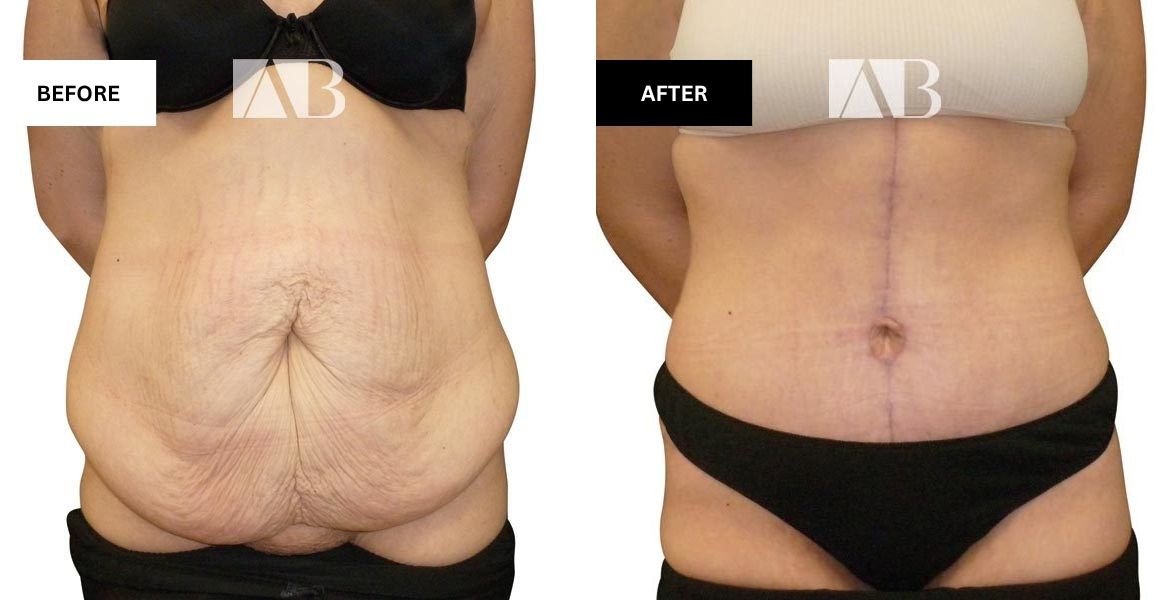 Tummy Tuck Before and After Photo Patient 8 - Front View