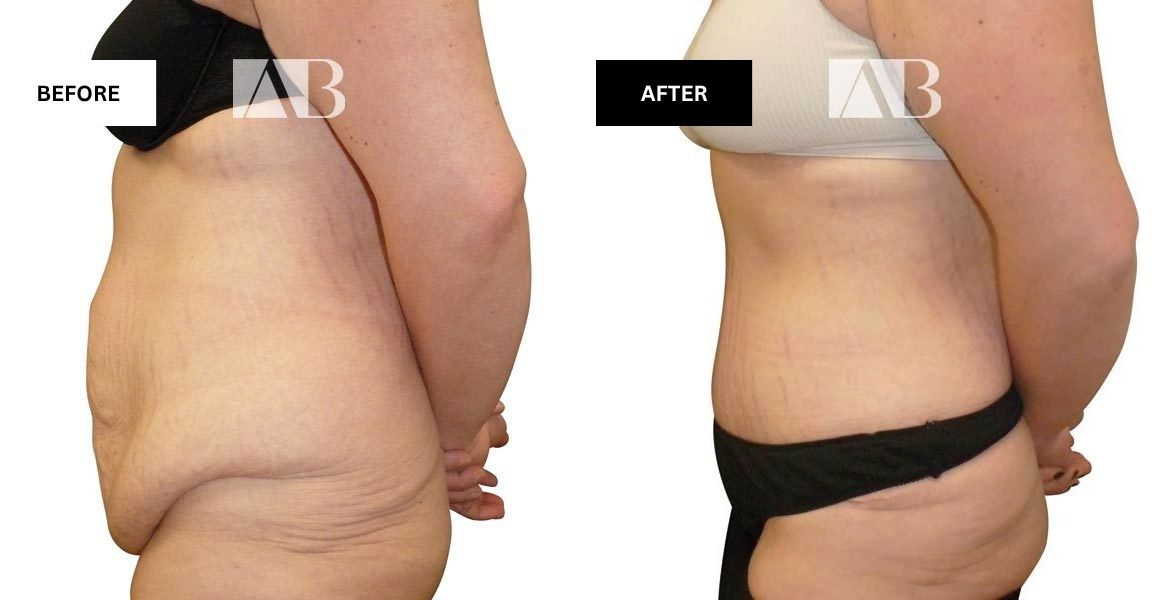 Tummy Tuck Before and After Photo Patient 8 - Left Side