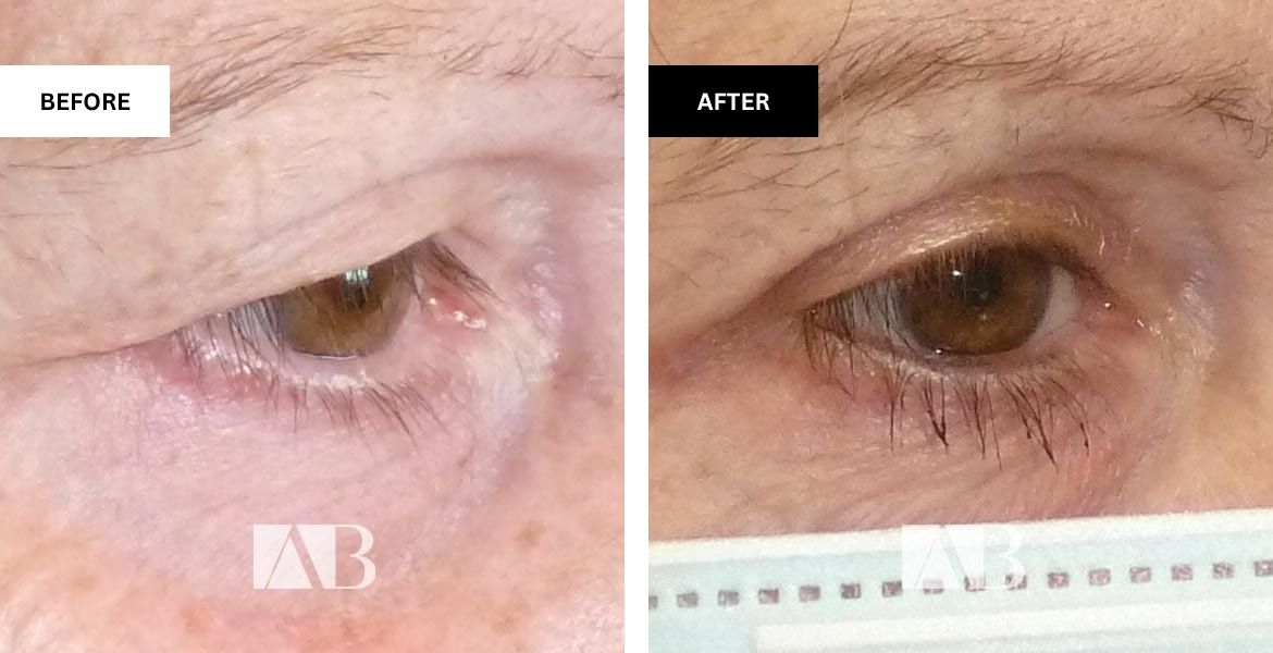 Blepharoplasty Before and After Photo – Patient 3 – 45 degree