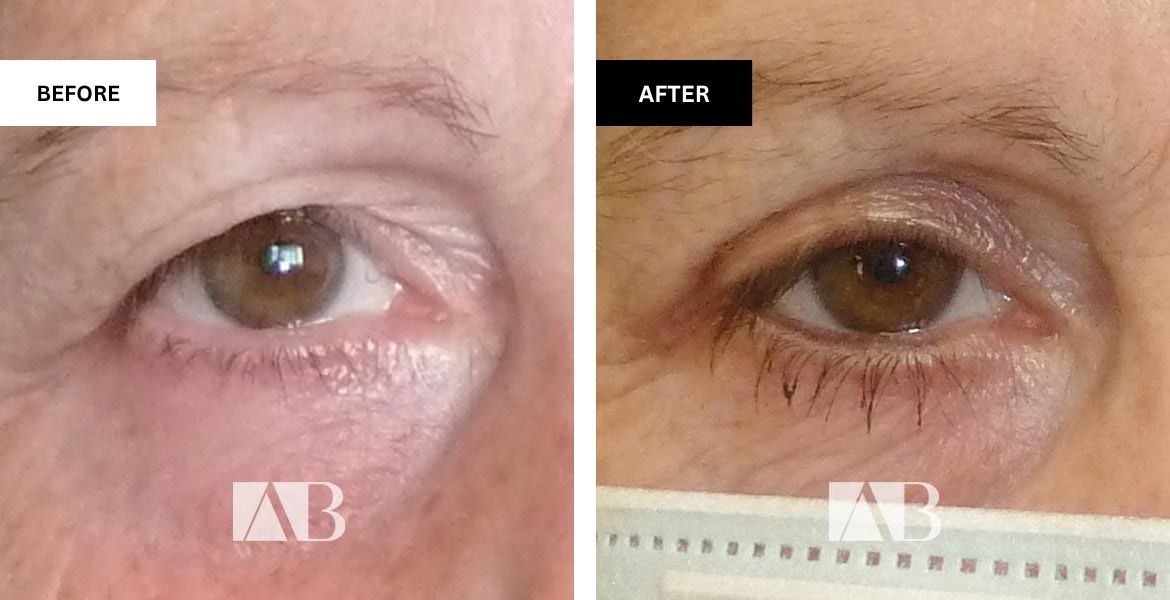 Blepharoplasty Before and After Photo – Patient 3 Right Eye