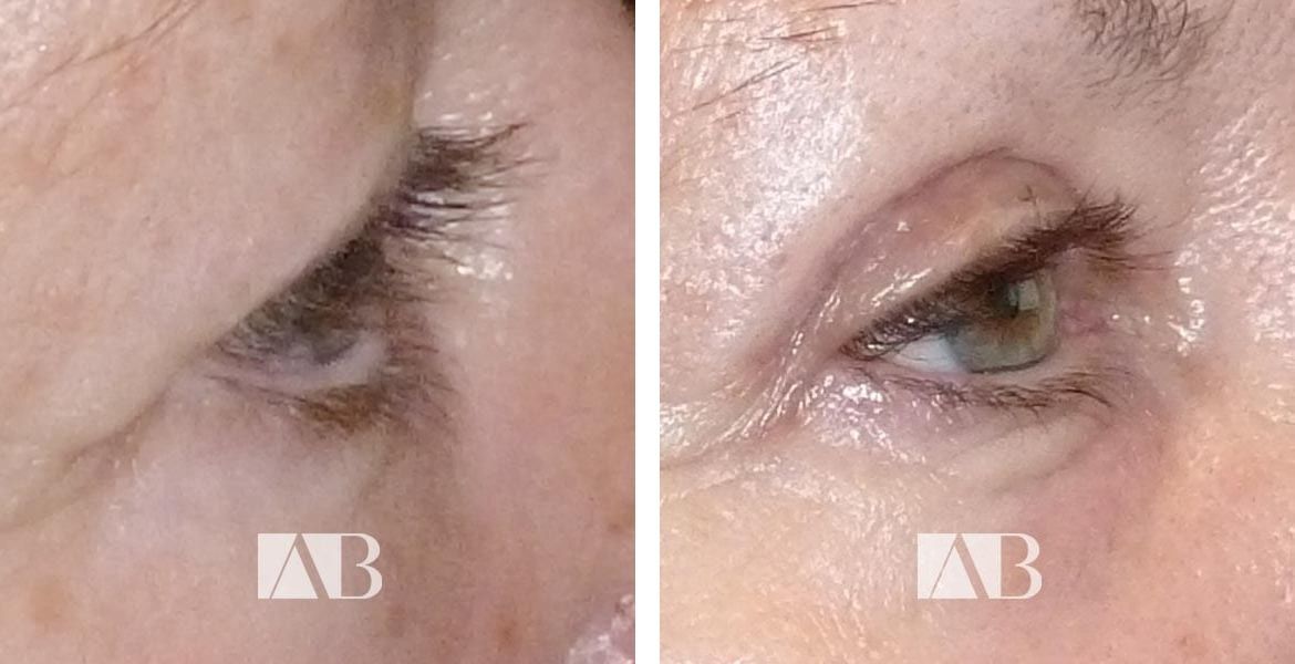 Blepharoplasty Before and After Photo - Patient 4 - 45 degree