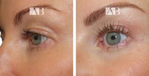 Blepharoplasty Before and After Photo - Patient 5 - 45 degree