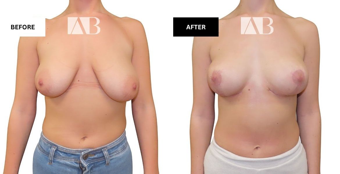 Breast Uplift Before and After Photo - Patient 4 Front View - Ancabreahna image