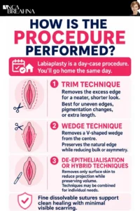 How Is Labia Minora Removal Performed Infographics - Anca Breahna