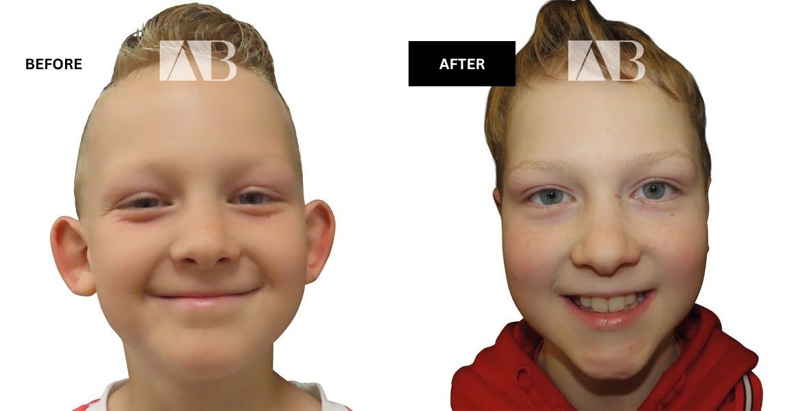 Pinnaplasty Before and After Photo – Patient 1 Front View