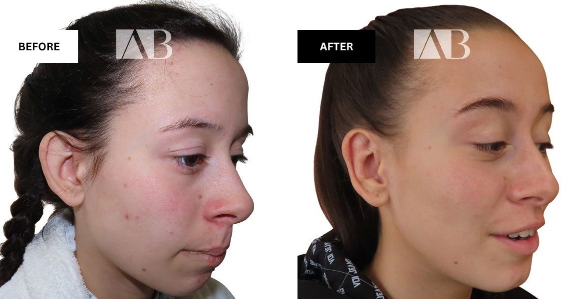 Pinnaplasty Before and After Photo – Patient 2 – 45 degree