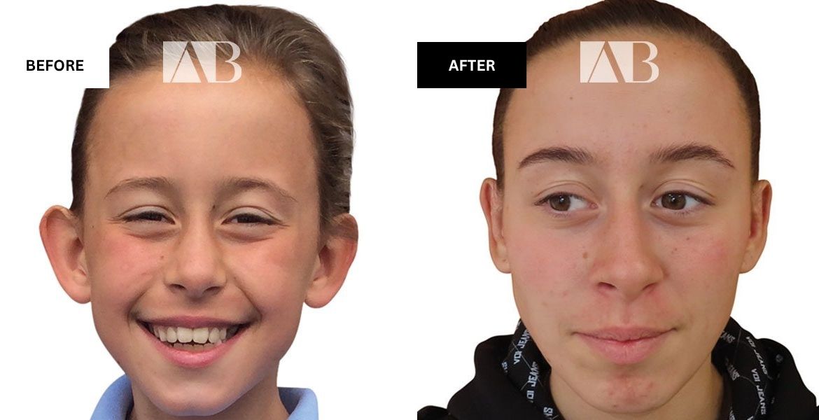 Pinnaplasty Before and After Photo – Patient 2