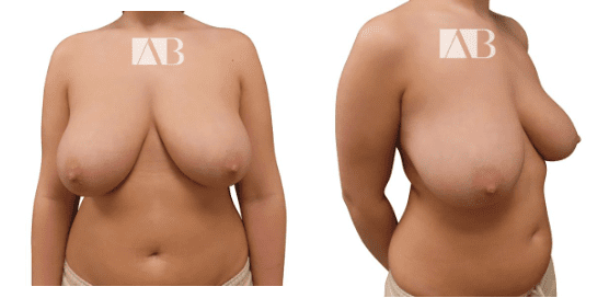 After Anca Breahna-Breast Reduction Before and After Image