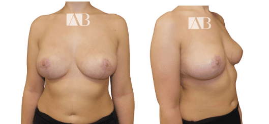After Anca Breahna-Breast Reduction Before and After Image
