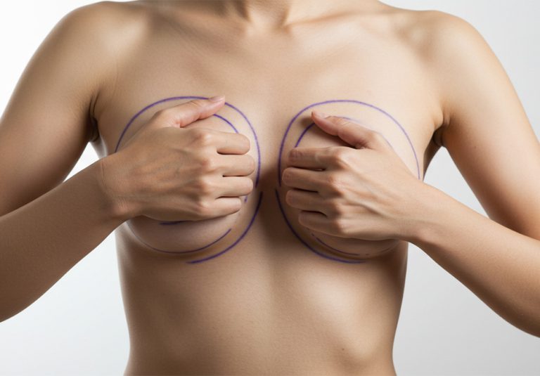 Breast Reduction ay Wirral Peninsula by Dr Anca Breahna