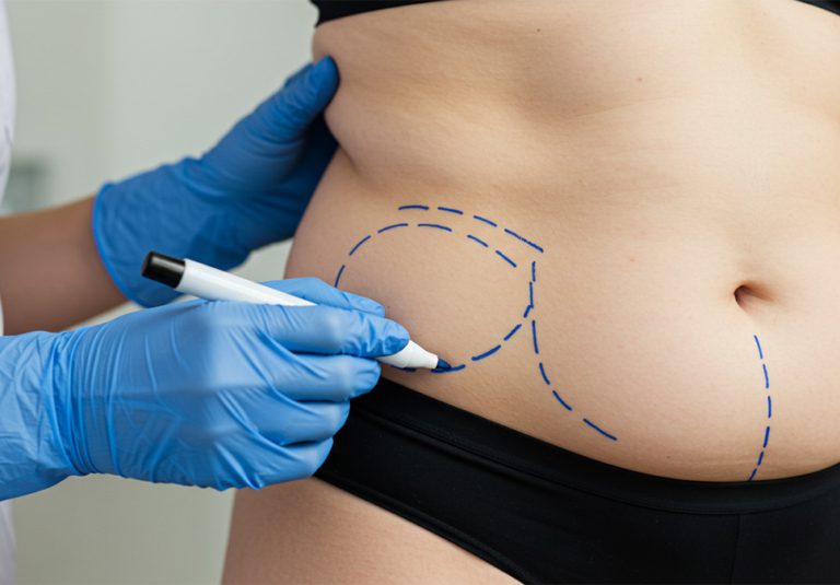 Fat Transfer North Wales by Dr Anca Breahna