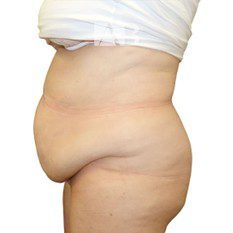 Pre-op Tummy Tuck P1 Side