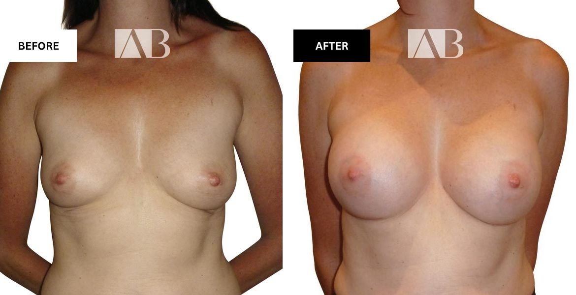 Breast Enlargement Before and After Photo - Patient 10 Front View