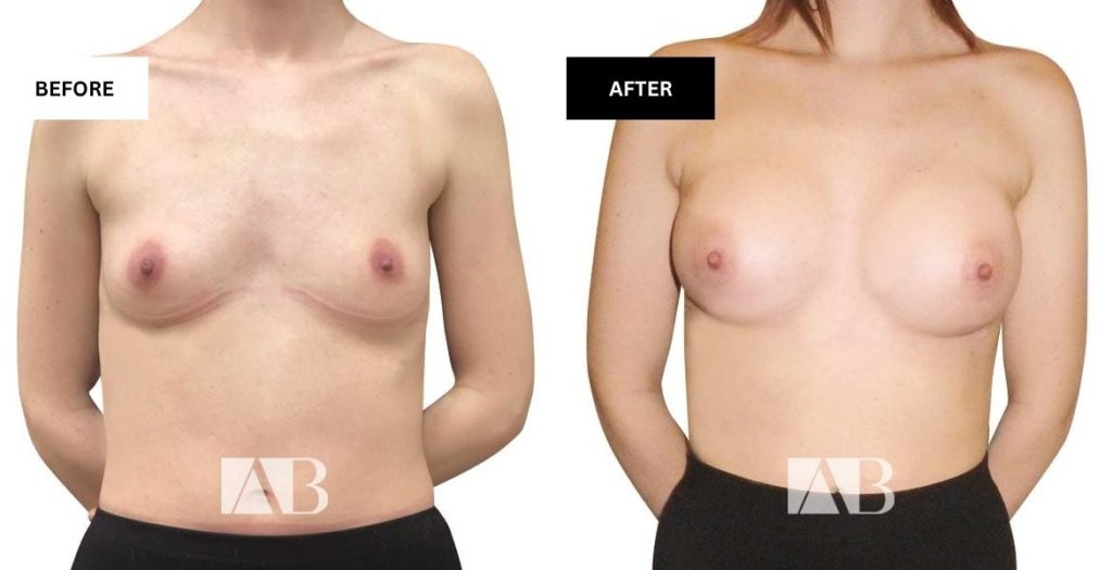 Breast Enlargement Before and After Photo - Patient 14 Front View
