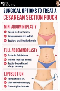 How To Get Rid of a Caesarean Section Pouch Infographics - Anca Breahna