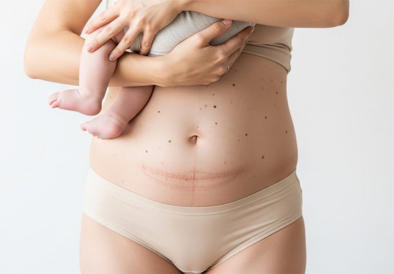 Solutions for a C-Section Belly by Dr Anca Breahna