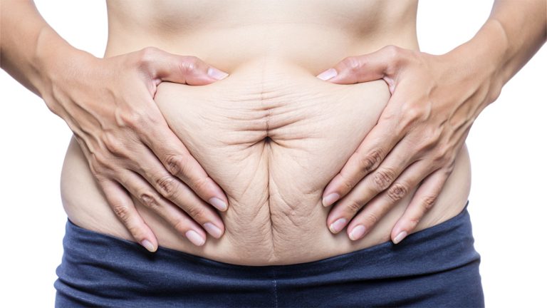 Surgery for Diastasis Recti – Muscle Repair Explained by Dr Anca Breahna