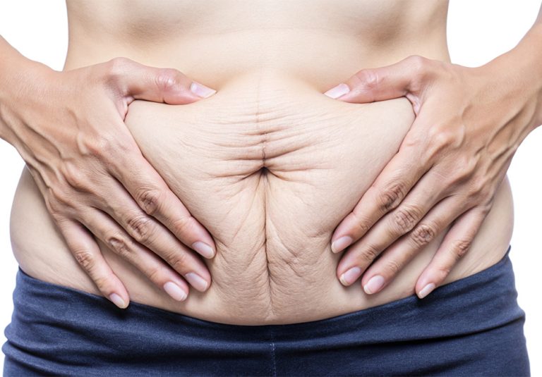 Surgery for Diastasis Recti – Muscle Repair Explained by Dr Anca Breahna