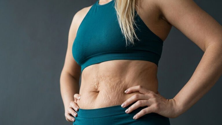 Drains or Drainless Tummy Tuck – The Pros and Cons by Dr Anca Breahna