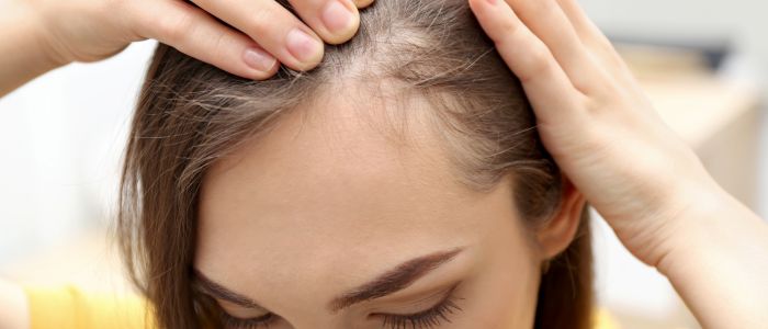 Types of scarring hair loss Image Anca Breahna