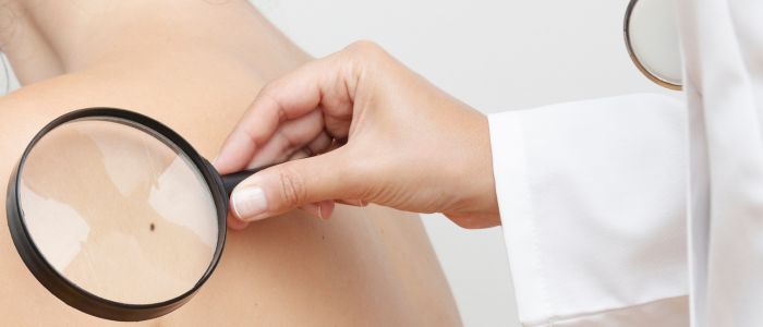 diagnosis of skin cancer image